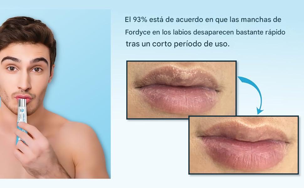 💥 ¡Despídete de las manchas de Fordyce y dile🧴HOLA a unos labios suaves perfectos! 👄✨